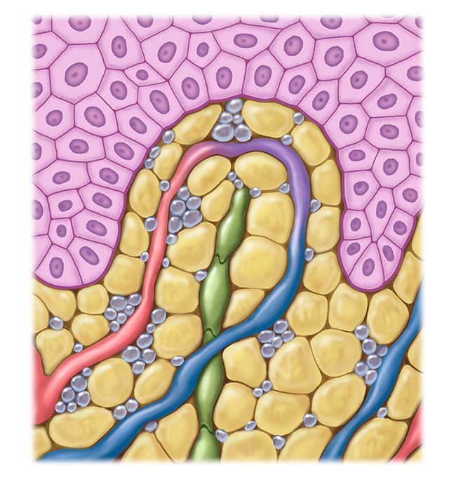 Figure affected lymphatic system Figure affected lymphatic system